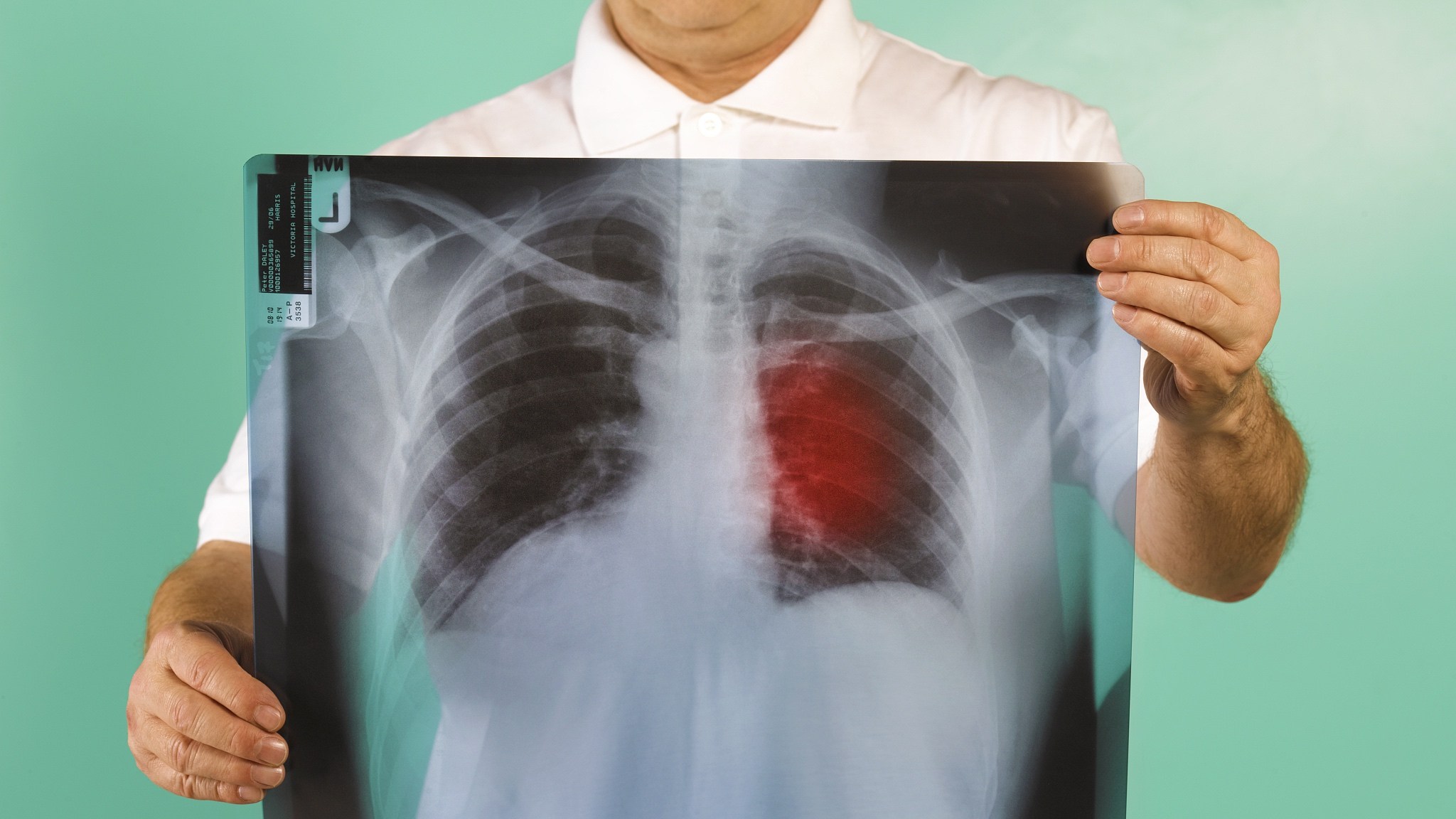Заболевание лёгких симптомы
