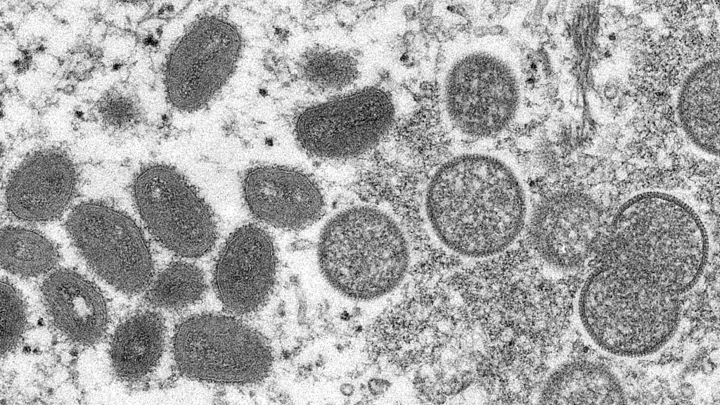 This 2003 electron microscope image shows mature, oval-shaped monkeypox virions (L) and spherical immature virions (R) obtained from a sample of human skin associated with the 2003 prairie dog outbreak. /CFP