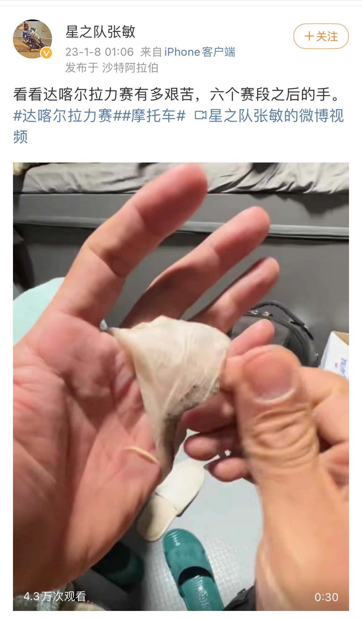 A screenshot of Zhang Min's Weibo post on January 8 shows his blister on the hand after Stage 6 at 2023 Dakar Rally. /Zhang Min 