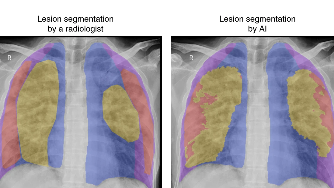 An example of lung-lesion segmentation caused by viral pneumonia of a chest X-ray image. /Screenshot of the study from Nature Biomedical Engineering