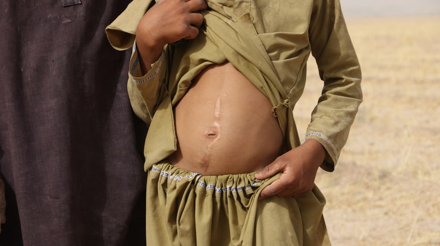 A boy shows his belly hurt by a blast of unexploded ordnance left by U.S. forces in Farah Province, Afghanistan, July 26, 2023. /Xinhua