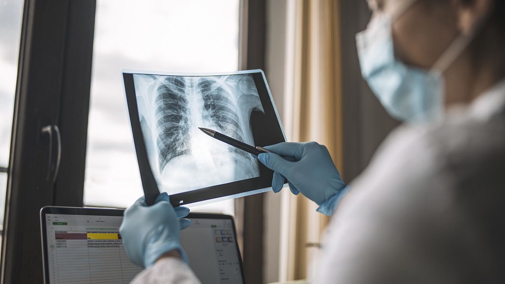 A doctor reviews a lung X-ray image. /CFP