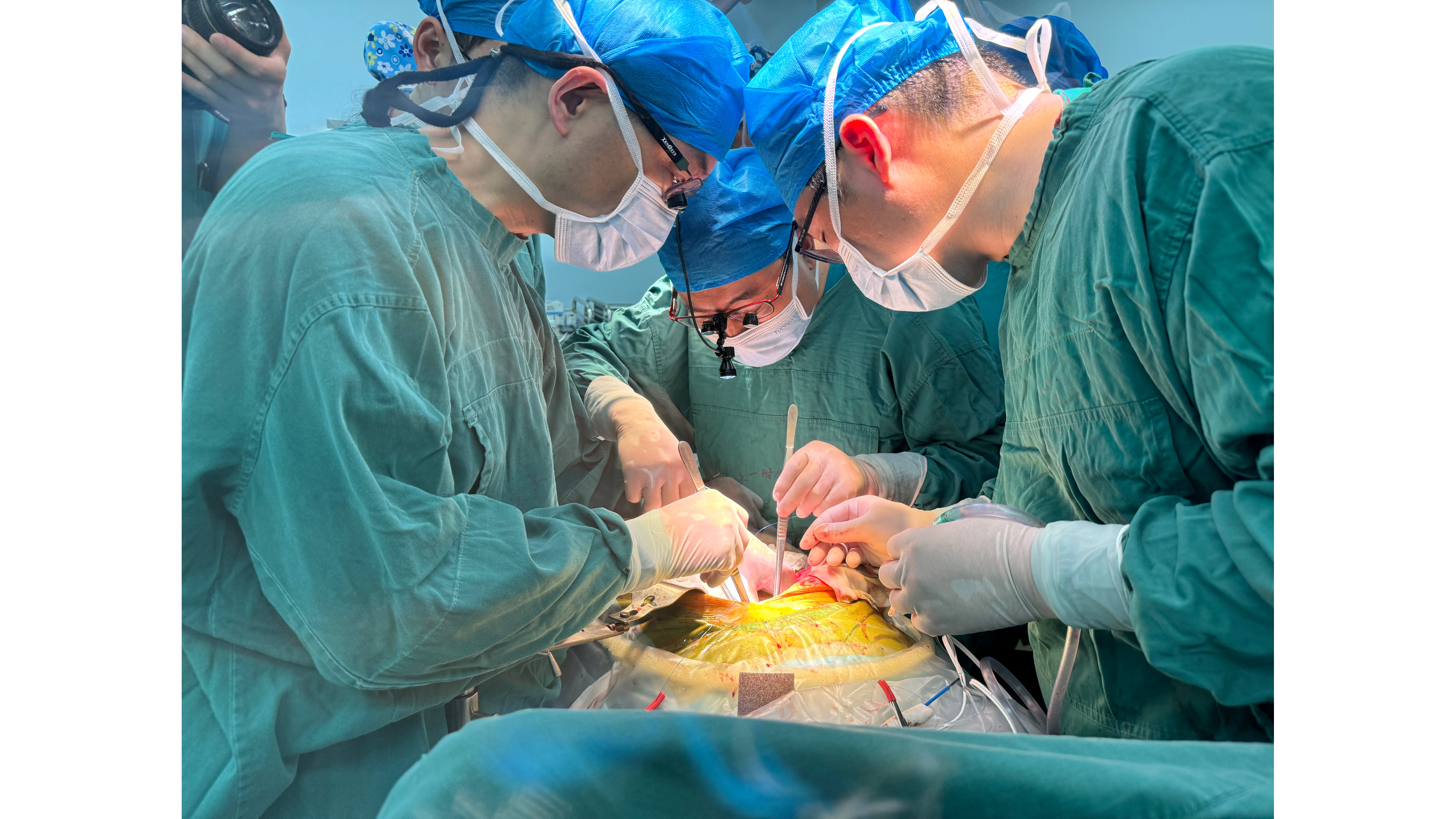 Surgeons transplant a pig liver into a 71-year-old male patient on May 17, 2024. /First Affiliated Hospital of Anhui Medical University