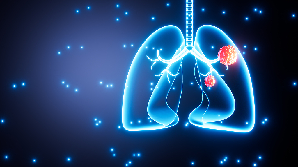 Up to 1 in 5 lung cancer patients are nonsmokers: study