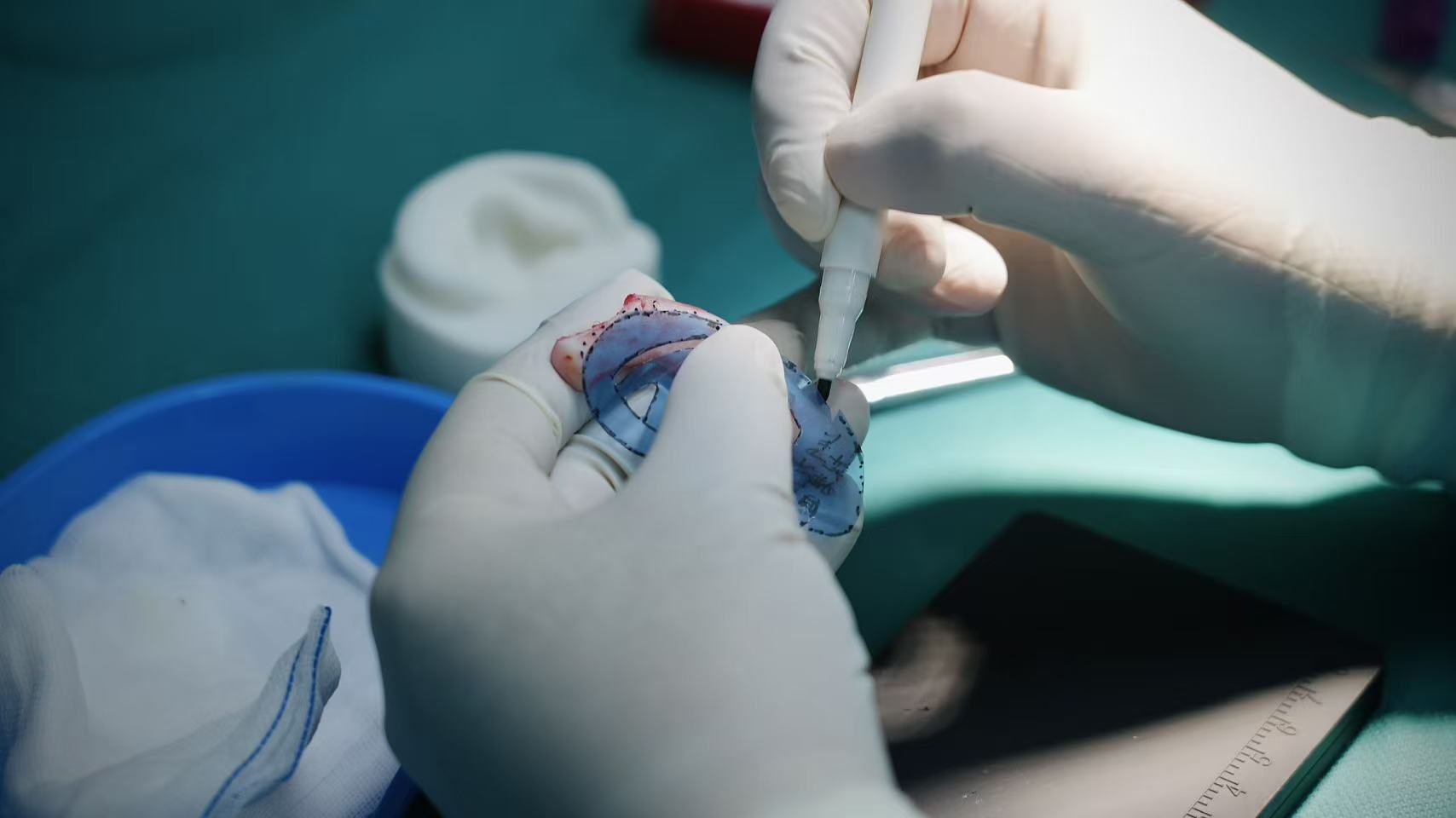 Professor Guo processes the cartilage based on the auricular template. /CGTN