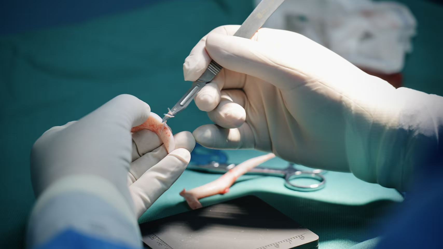 Professor Guo carves the costal cartilage to shape the ear framework. /CGTN