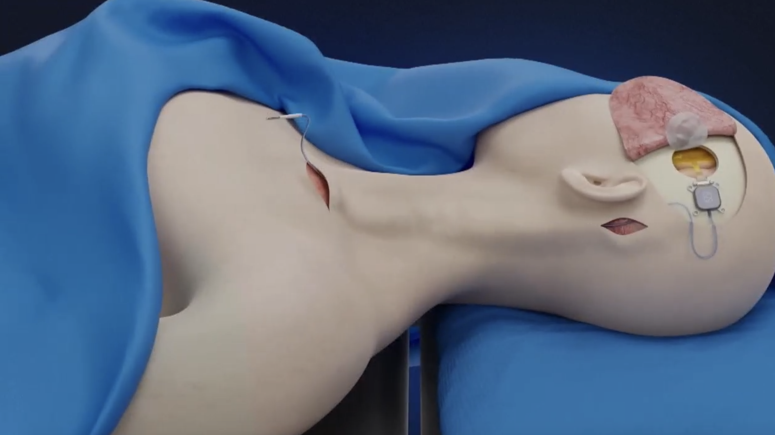 An illustration of a BCI implantation surgery. /CMG