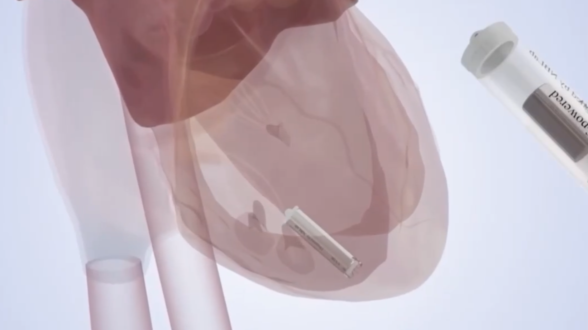 A cardiac pacemaker is implanted in a heart. /CMG