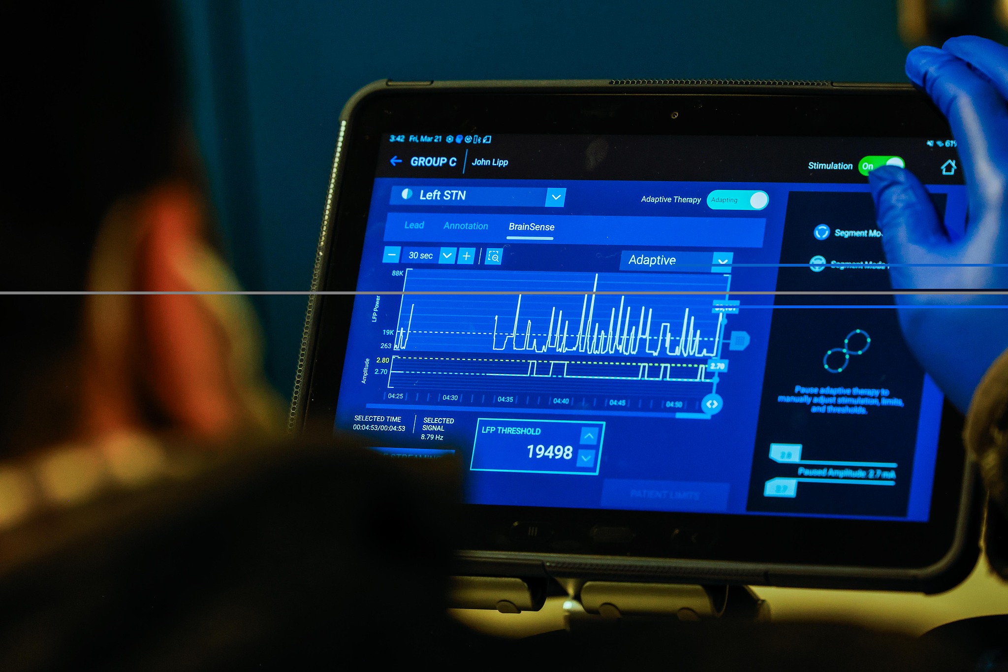 Stanford neurologist Gaurav Chattree monitors a patient receiving adaptive deep-brain stimulation, an FDA-approved personalized Parkinson's treatment, at the Stanford Neuroscience Health Center, California, United States, March 21, 2025. /CFP