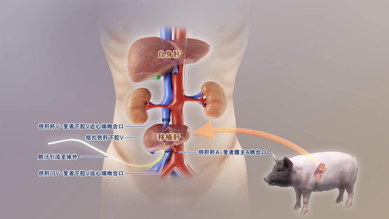 Gene-edited pig liver transplant demonstrates feasibility. /CMG