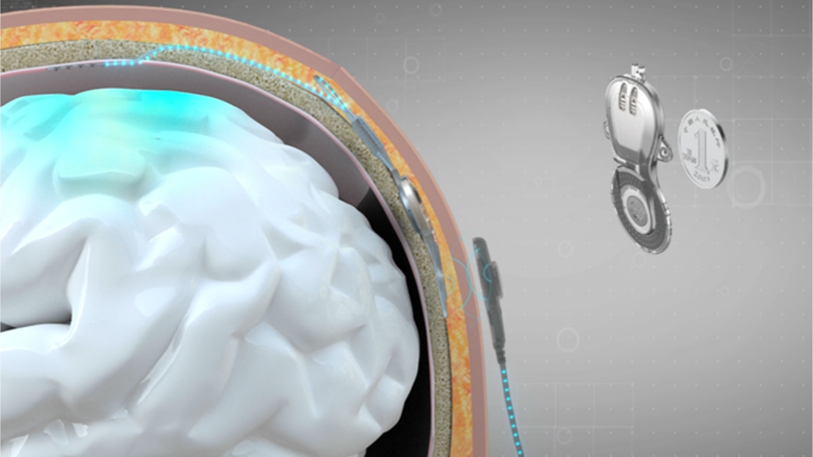 Illustration of the implantable brain-computer interface (BCI) medical device. /Tsinghua University