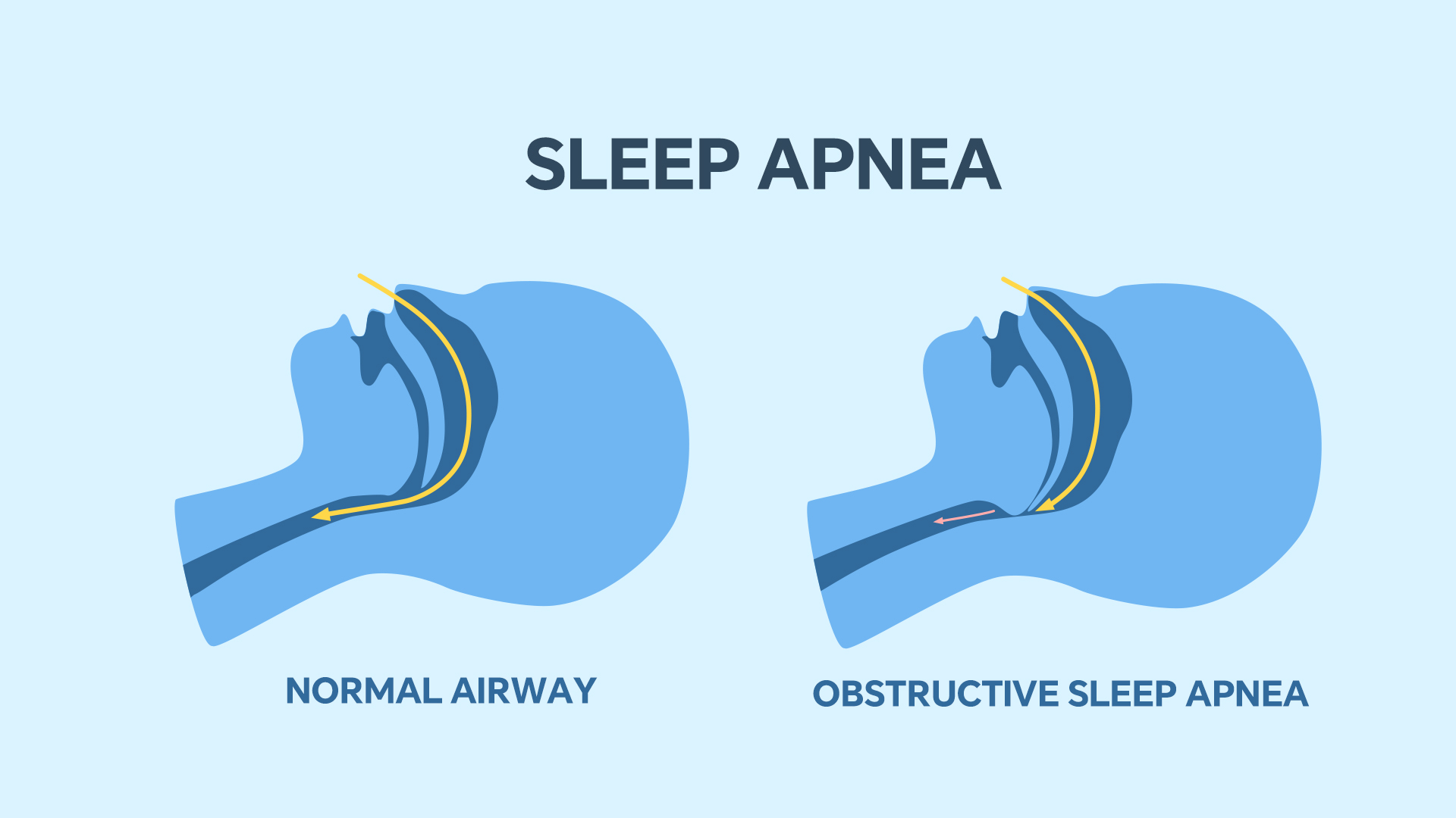 Diagram detailing sleep apnea. /ICphoto