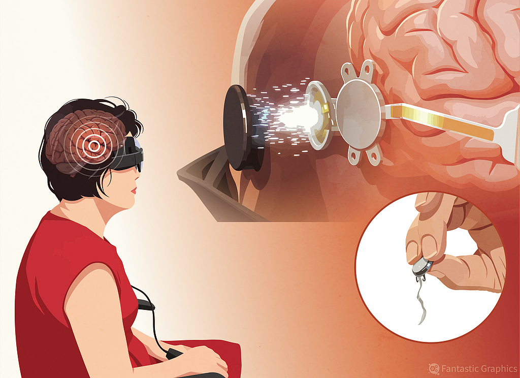 An illustration of China's first completely blind patient regaining basic visual function after receiving a brain-computer interface implant. /VCG