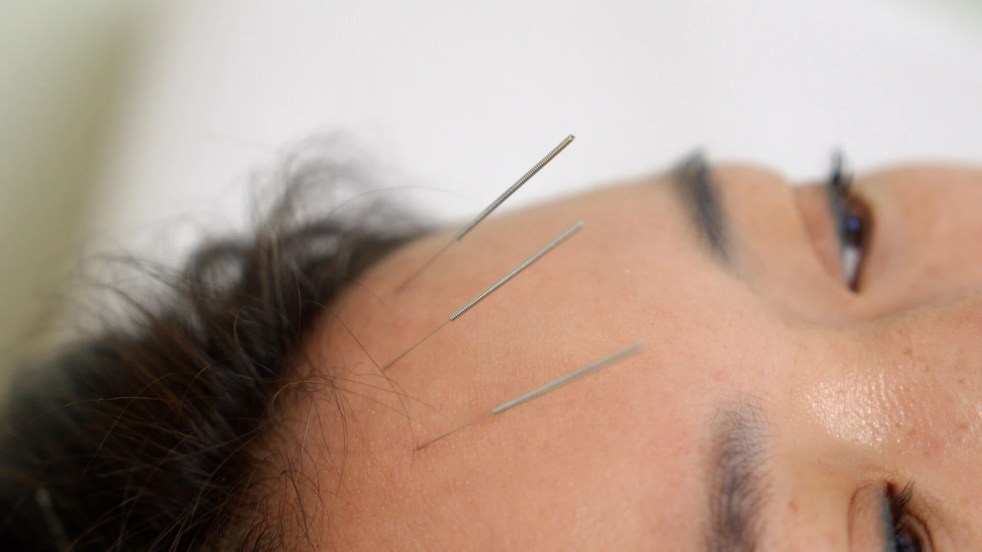 A participant experiences acupuncture at Peking Union Medical College Hospital, Beijing, China, July 17, 2026. /CGTN