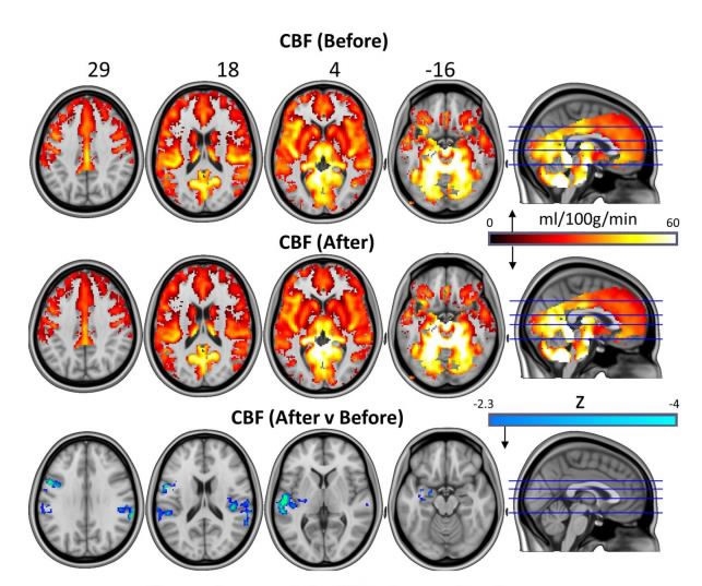 Magic mushrooms help people with depression process emotions •