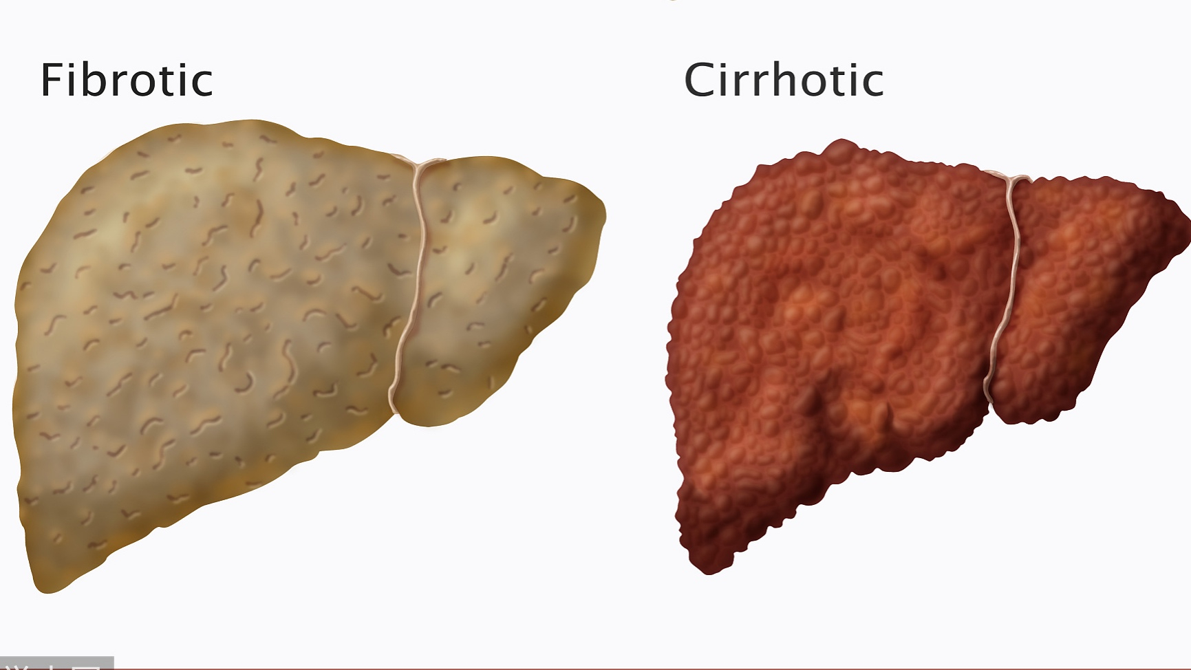 World Hepatitis Day: Find the missing million - CGTN