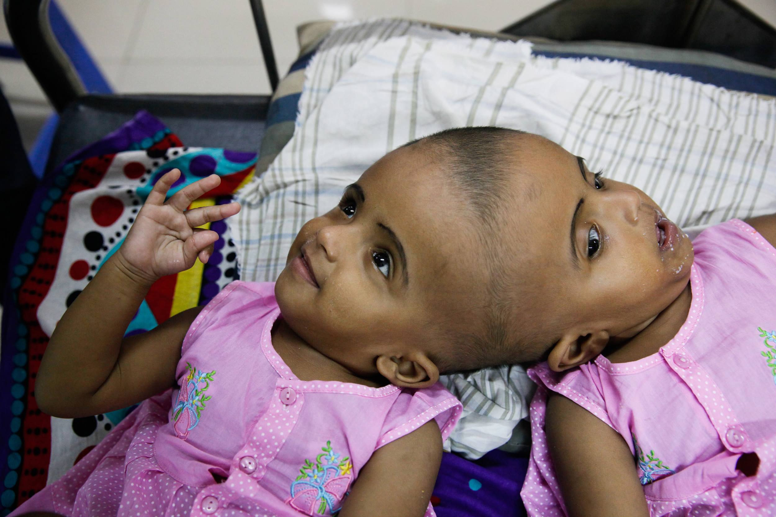 Bangladeshi conjoined twins expect surgery - CGTN